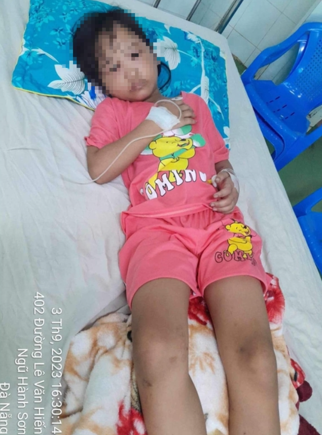 4 người ở Quảng Nam bị ong vò vẽ tấn công: Mẹ rơi vào cơn nguy kịch, 3 con nhỏ thương tích đầy người - Ảnh 3